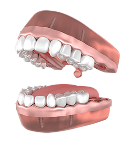 permanent implant dentures